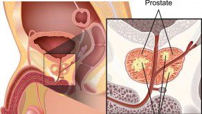 Vigilar el cáncer de próstata es tan efectivo como la cirugía o radioterapia