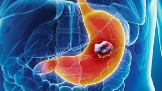 Añadir un nuevo fármaco mejora los resultados de pacientes de cáncer gástrico