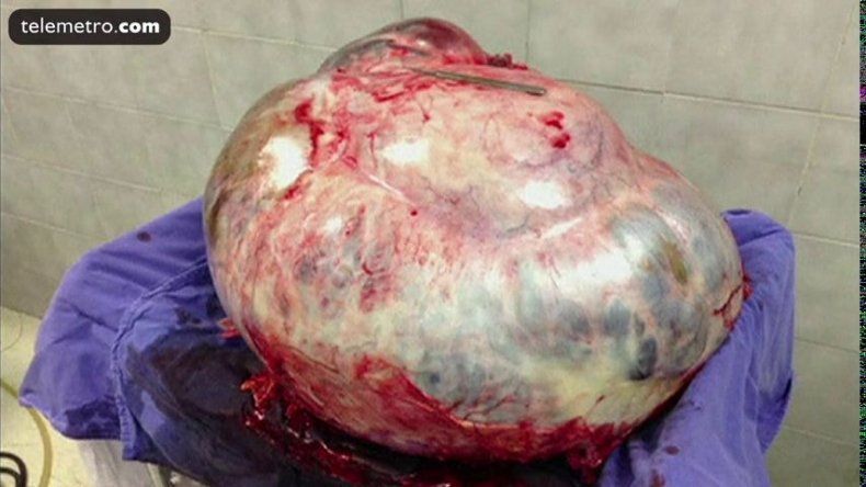 Extirpan a una mujer mexicana un tumor de 60,2 kilos en un ovario