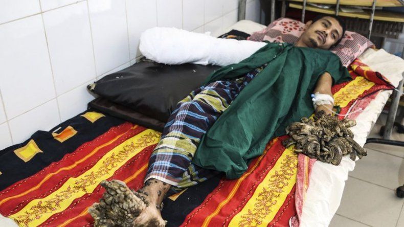 El hombre árbol de Bangladesh quiere volver a trabajar tras ser operado