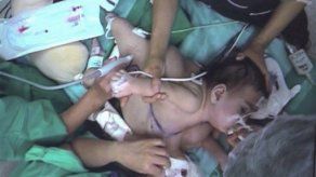 Siguen graves siamesas chilenas separadas