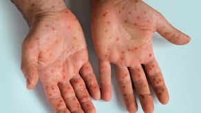 El mpox deja de ser una urgencia de salud internacional.