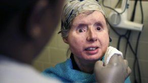 Ingresan por complicaciones a paciente de trasplante facial