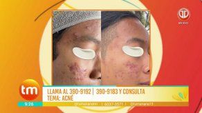 ¿Cuál es la manera correcta de controlar el acné?