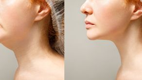 Ejercicio hacer para mejorar la apariencia de la papada