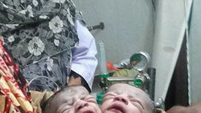 Nace un niña con dos cabezas en Bangladesh