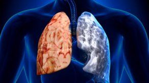 Covid-19 pone en riesgo a enfermos de EPOC sin diagnóstico en Latinoamérica