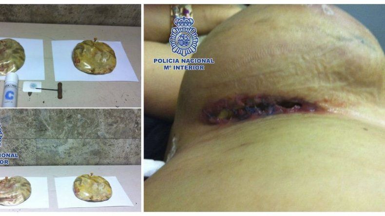 España: Mujer llevaba cocaína en implantes de seno