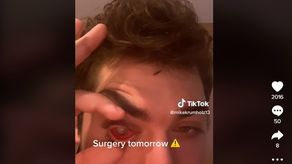 Joven se queda dormido con sus lentes de Contacto y el resultado fue desastroso
