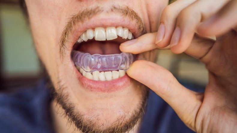 Zanni Dental - 🔹 𝔹𝕣𝕦𝕩𝕚𝕤𝕞𝕠⁣ El Bruxismo es una Parafunción  Mandibular Persistente que se conoce comúnmente como Rechinar de los  Dientes. Éste se puede producir durante el día o por la noche.