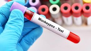 Viruela símica: Minsa reporta 10 casos nuevos en Panamá