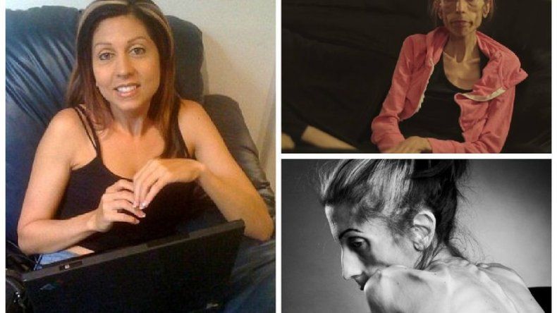 Una mujer anoréxica en EEUU pide ayuda en internet para salvar su vida