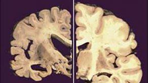 Prueban marcapasos cerebral contra el Alzheimer