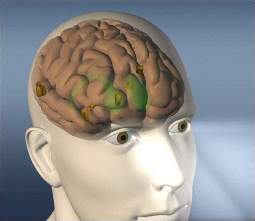 Señales del Alzheimer pueden detectarse 10 años antes
