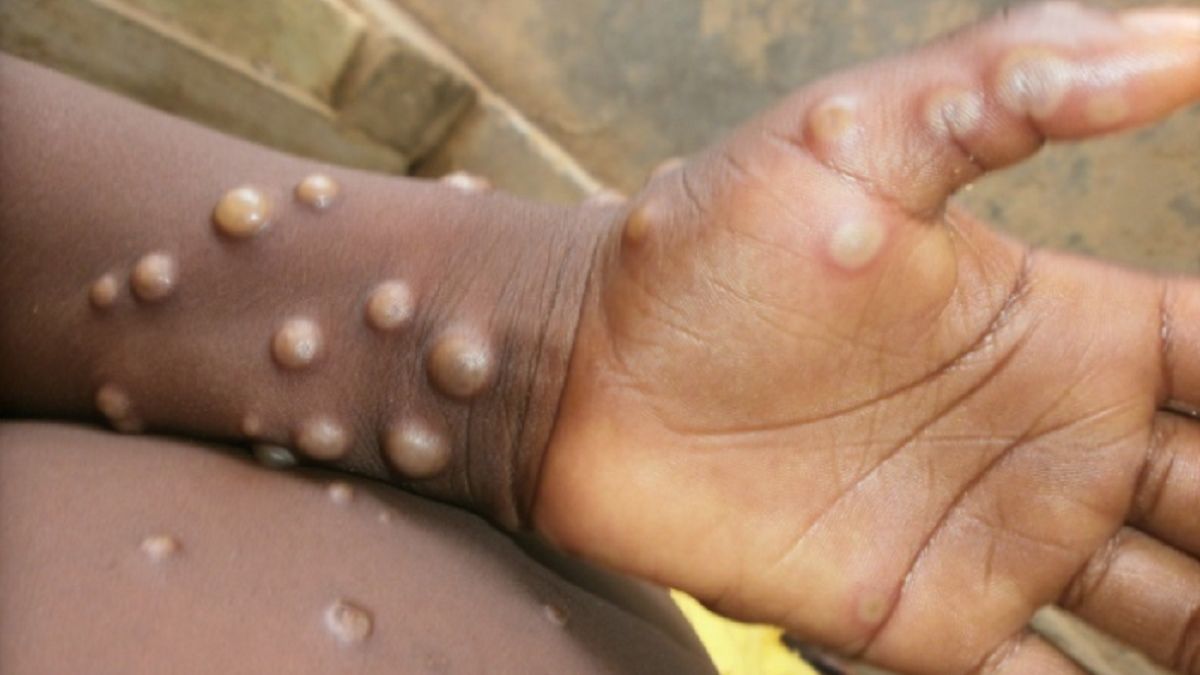 Los síntomas de la viruela del mono incluyen fiebre, dolores musculares e inflamación de los ganglios linfáticos, antes de provocar una erupción parecida a la varicela en el rostro y el cuerpo.