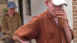 Decapitan a niña albina de seis años en crimen ritual