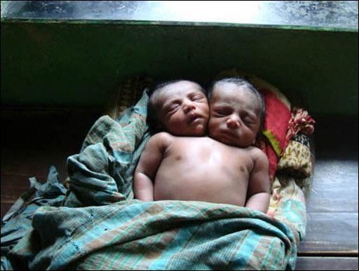 Un niño con dos cabezas nació en Bangladesh