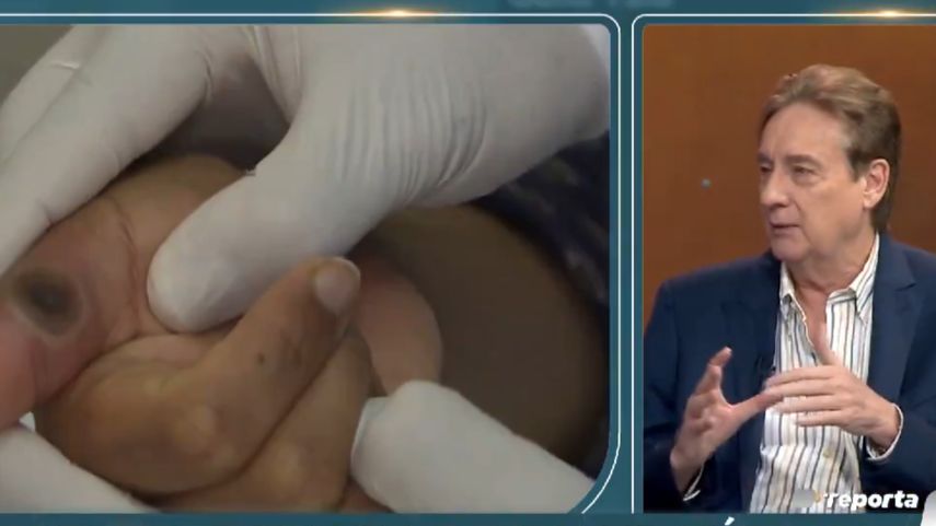 Viruela del Mono: Xavier Sáenz Llorens brinda recomendaciones