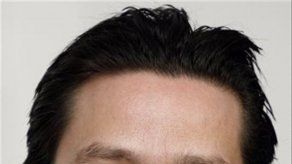 Alemania: Transplante de médula cura un caso de sida