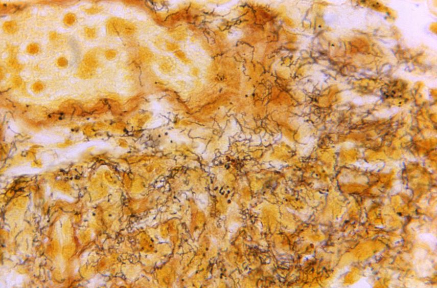 Las tasas de infección de algunas ETS