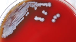 Los médicos estadounidenses deberían considerar la posibilidad de la presencia de melioidosis incluso en pacientes que no han viajado a otros países, dijeron los Centros para el Control y la Prevención de Enfermedades (CDC, por sus siglas en inglés) en una alerta sanitaria.