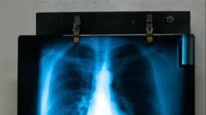 Identifican diversos tipos de pacientes de enfermedad pulmonar