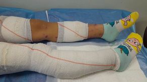 Tratamiento para el pie diabético en la CSS.