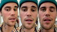 Justin Bieber anunacia una paralisis facial causada por el sindrome de Ramsay Hunt Justin Bieber anunacia una paralisis facial causada por el sindrome de Ramsay Hunt