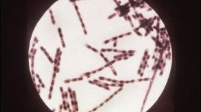 Ucrania: Hospitalizan a 5 infectados al parecer por ántrax