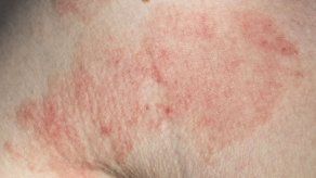 EEUU aprueba medicamento para dermatitis moderada y grave