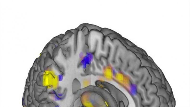 Logran medir el dolor cerebral con imágenes